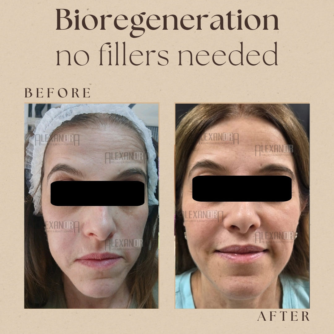 Before and after bioregeneration treatment comparison